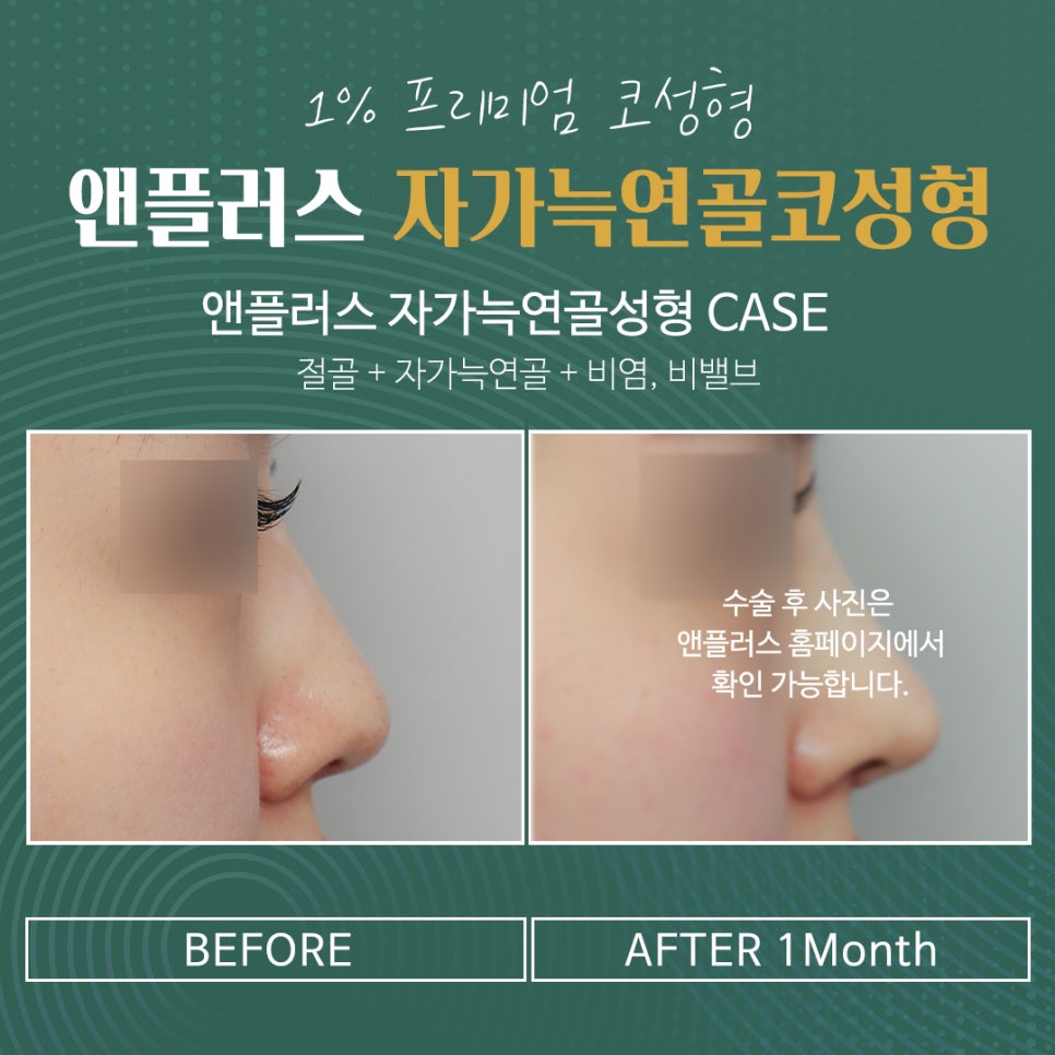 자가늑연골코수술로 처음부터 확실하게 관련 이미지 7