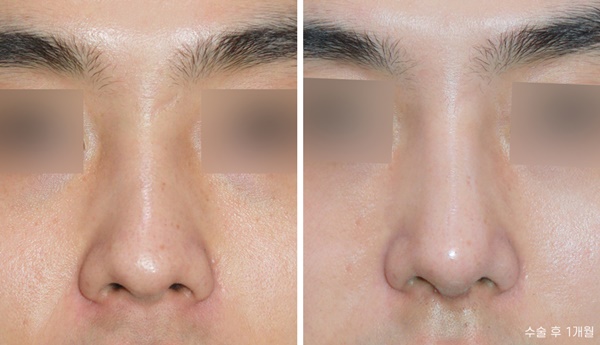 Male Nose Surgery Before and After: Tip Correction image 2