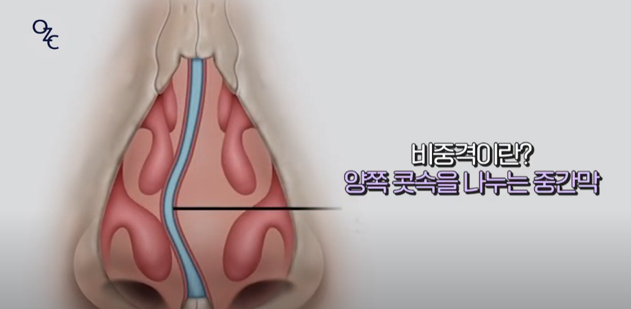 코뼈골절의 원인과 수술 방법에 대하여 관련 이미지 18