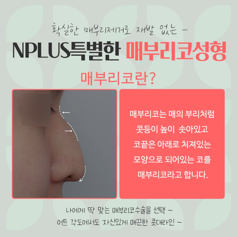 매부리코교정으로 부드러운 인상 관련 이미지 4