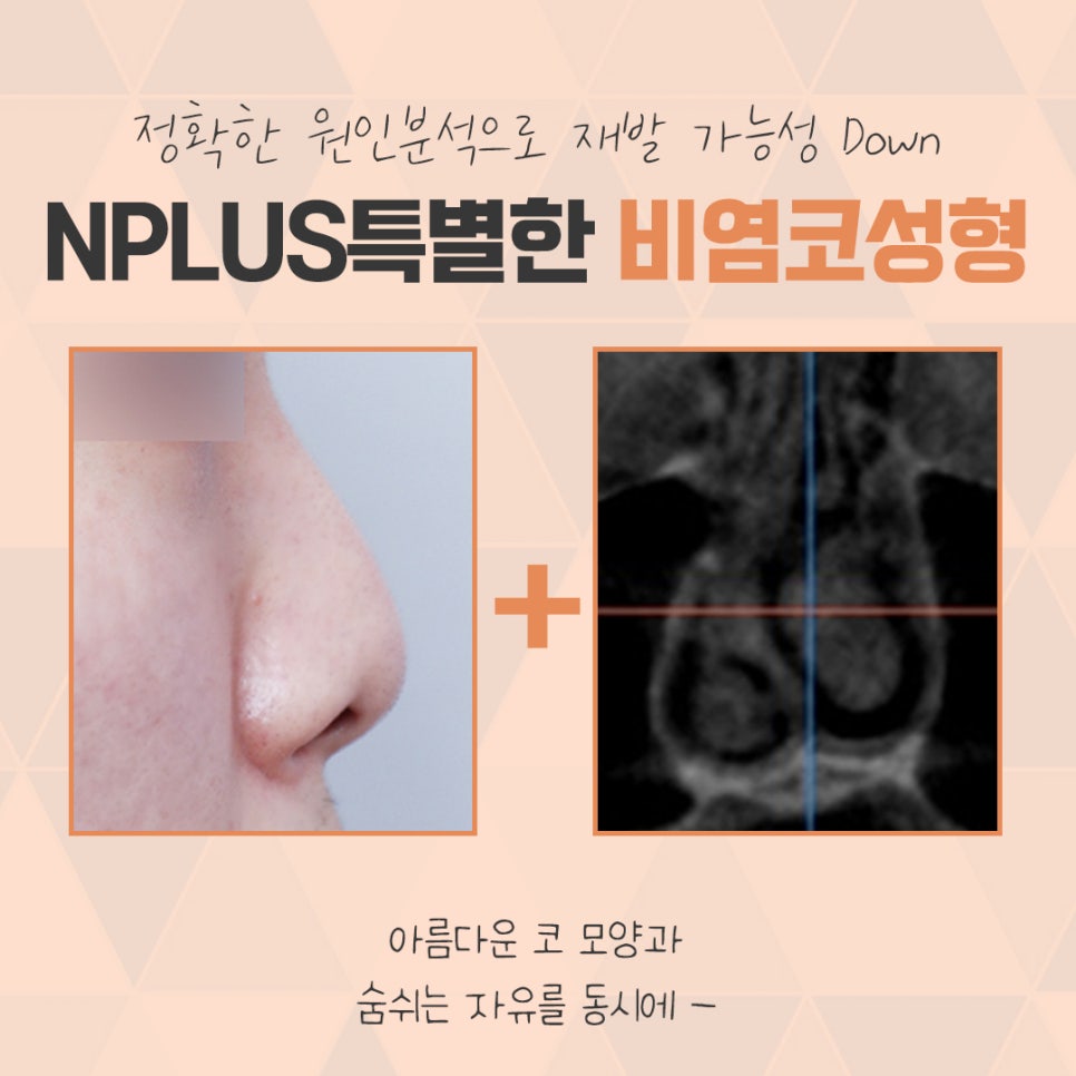 A Satisfying Result with One Rhinoplasty and Rhinitis Surgery image 4