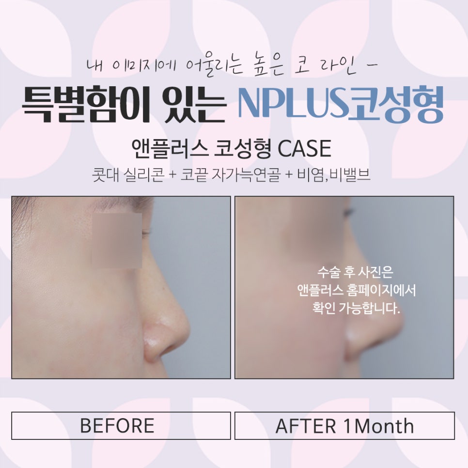 Nose Surgery Review: A Natural and Glamorous Line image 12