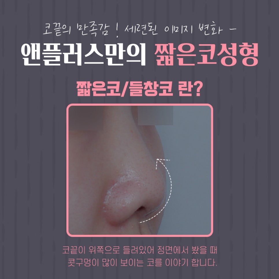 Image Transformation Through Upturned Nose Surgery image 4