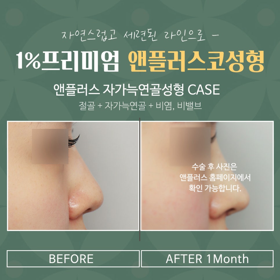 자가늑코성형 후기까지 확인하고 관련 이미지 16