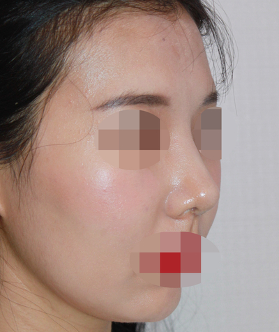 1_여자 매부리코 수술전후 관련 이미지 8