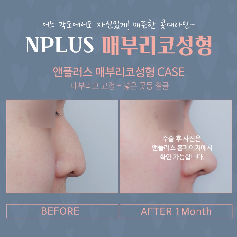 매부리코수술 후기까지 확인하고 관련 이미지 15