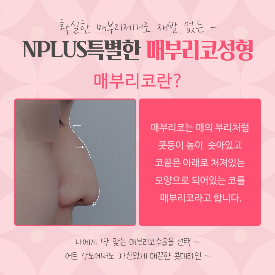 매부리코성형후기 내부까지 확인하고 관련 이미지 4