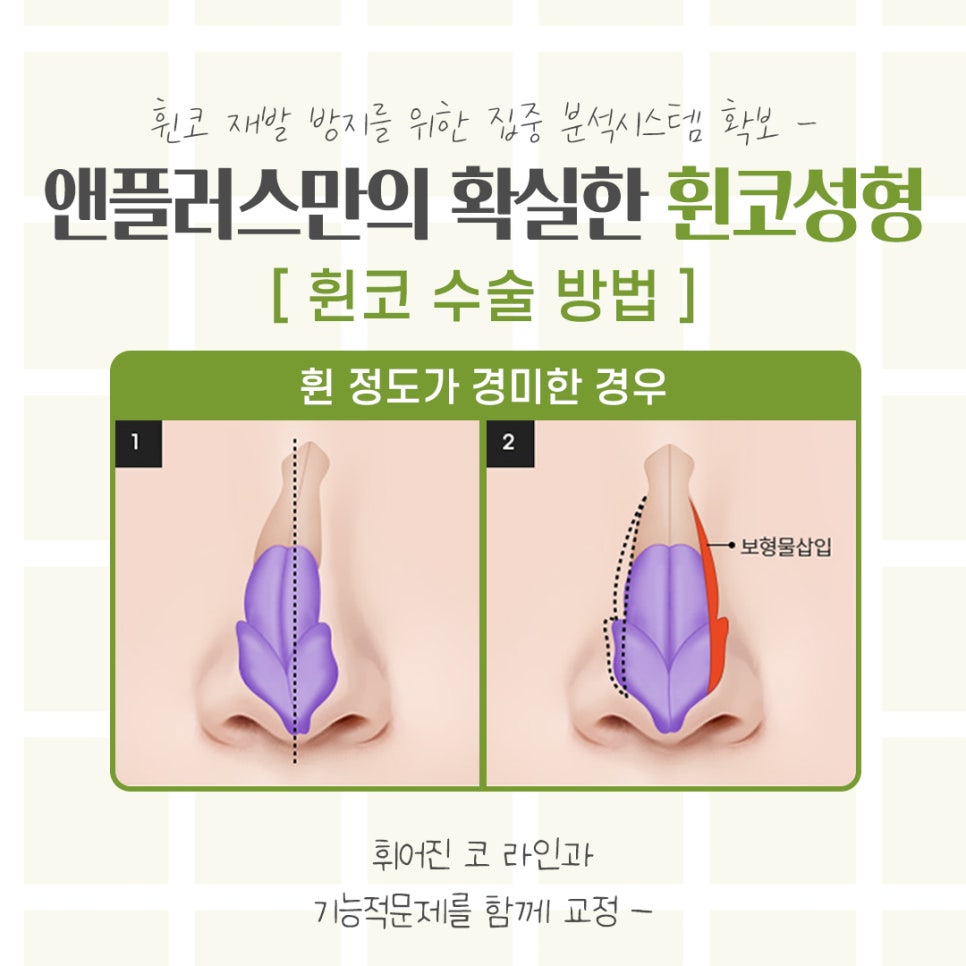 휜코수술에 대해 자세하게 확인하고 관련 이미지 8