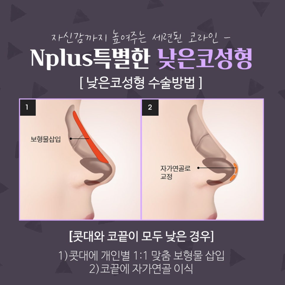 낮은코수술후기 세련된 코라인으로 관련 이미지 9