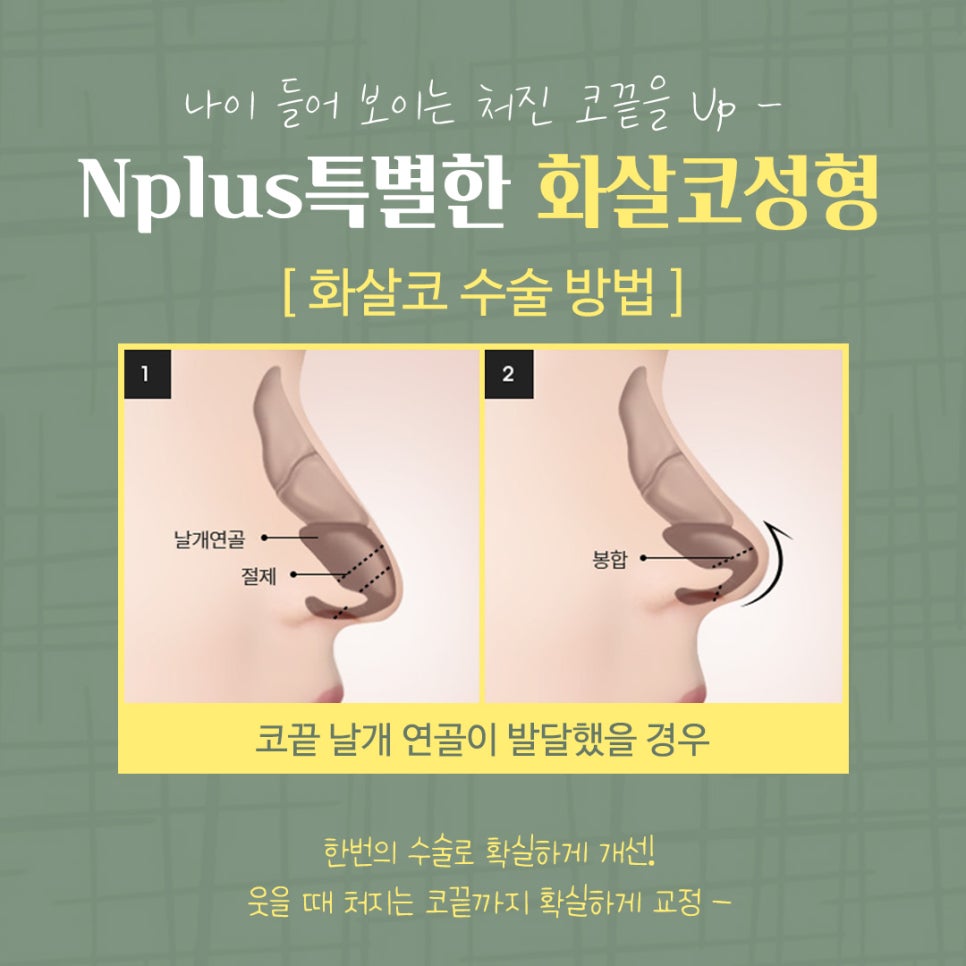화살코성형 후기까지 확실하게 관련 이미지 10