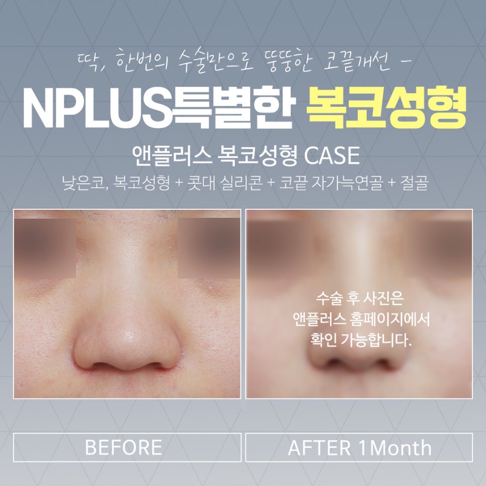 복코수술후기 조화로운 얼굴 라인 관련 이미지 15