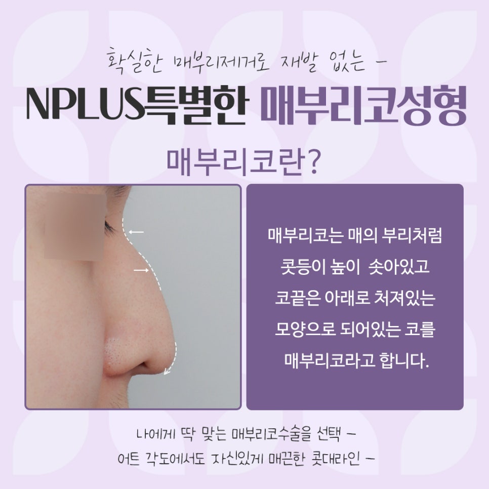 Check the Hump Nose Surgery Review in Detail image 4