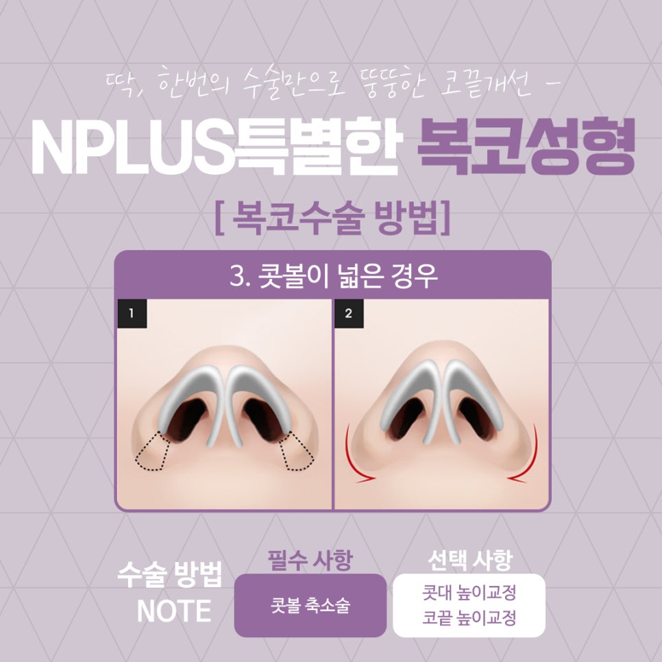 복코수술후기 슬림한 라인으로 관련 이미지 9