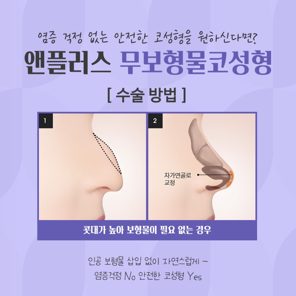 무보형물코성형 자가연골 활용으로 안전하게 관련 이미지 8