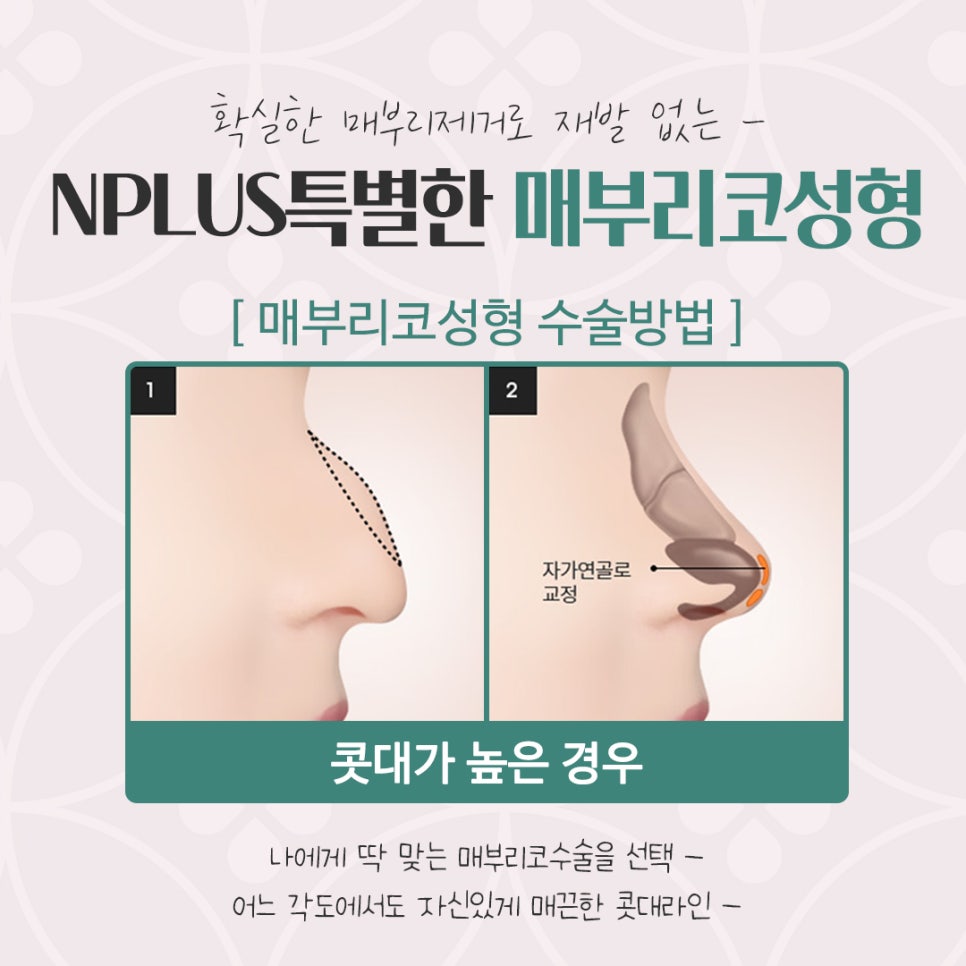 매부리코성형후기 다양한 내용을 찾아보고 관련 이미지 8