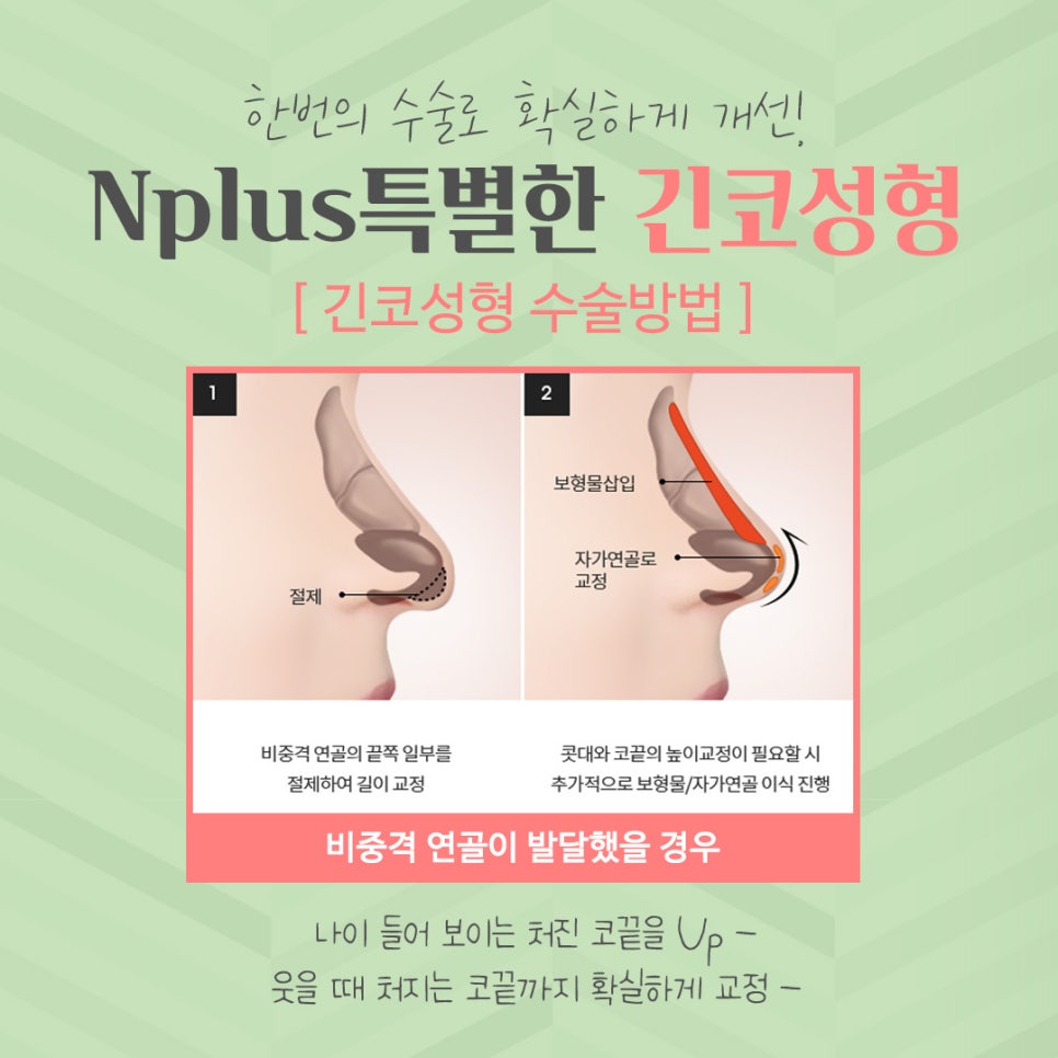 Long Nose Surgery: From Looking Older to Looking Younger image 7