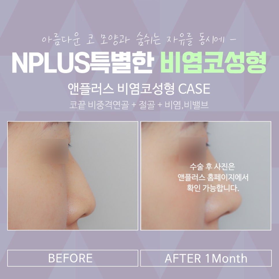 Rhinitis Surgery Review Based on an Accurate Diagnosis image 14