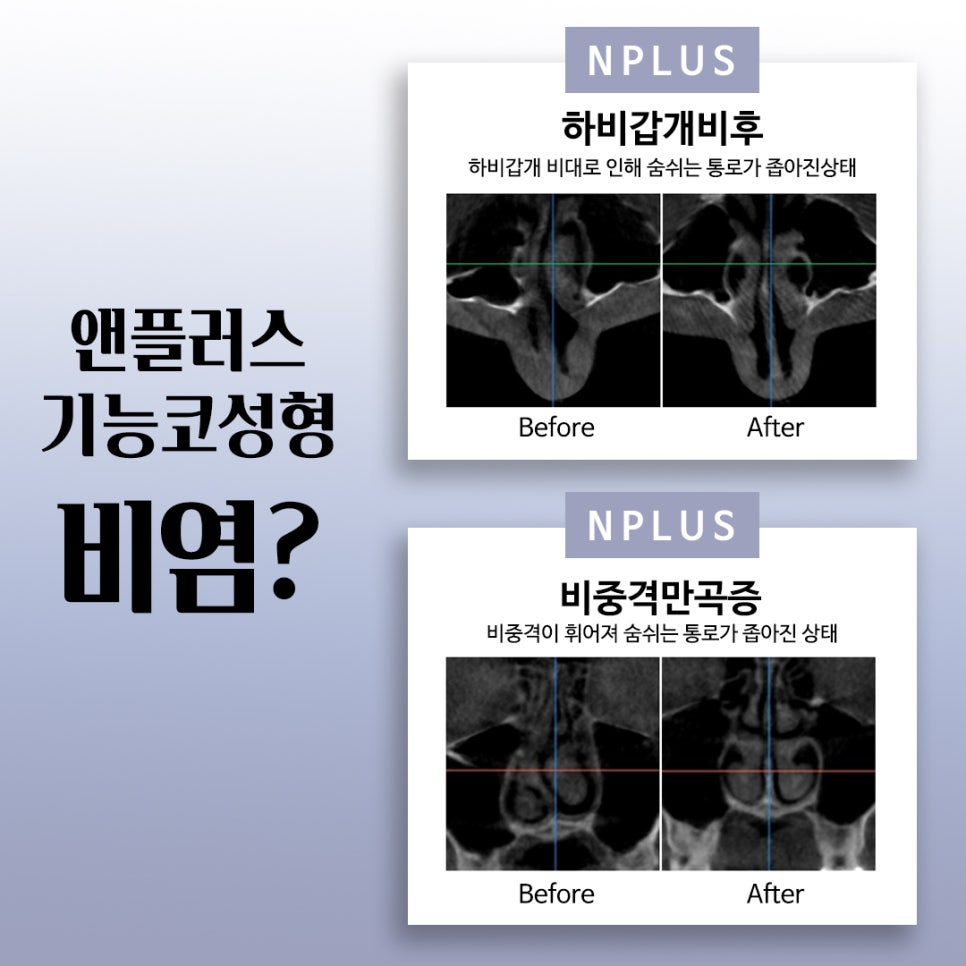 기능코성형비용에 대해 자세히 찾아보고 관련 이미지 4