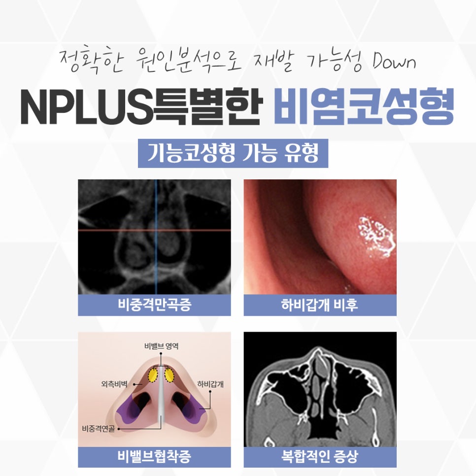 Nasal Surgery and Rhinoplasty: Identifying the Exact Cause image 6