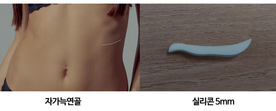 Creating a Straight-But-Slightly-Curved Nose Line with Columella Reduction image 8