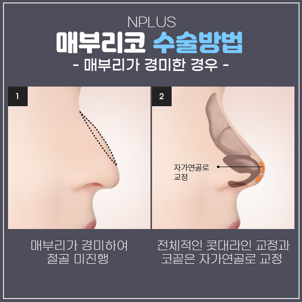 Improving Both the Function and Appearance of a Hump Nose in Men image 4