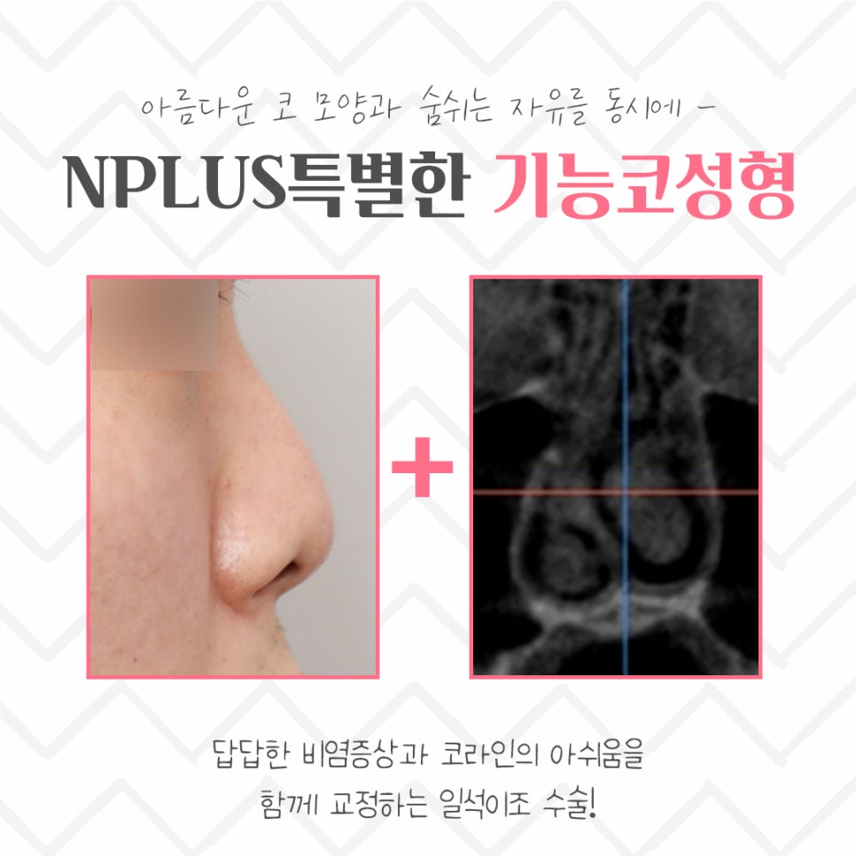 기능코성형후기 원인 파악을 확실하게 관련 이미지 3