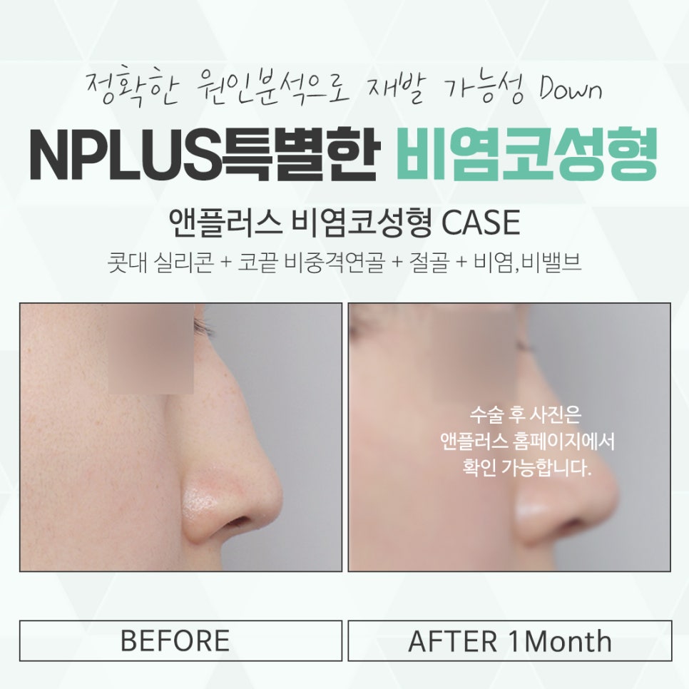 Check Nasal Surgery and Rhinoplasty in Detail image 15