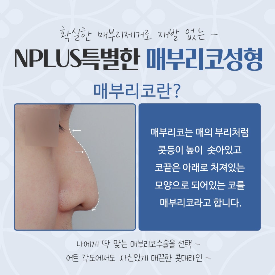 Hump Nose Surgery Review with an Accurate Diagnosis image 4