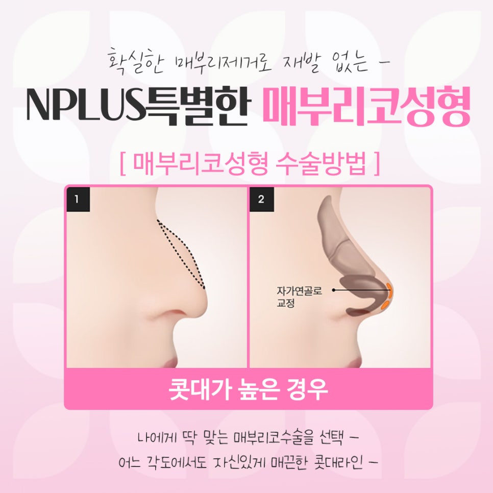 매부리코수술전후 비교를 한다면 관련 이미지 8