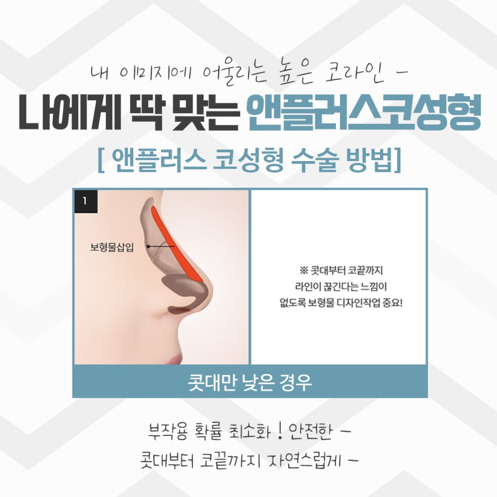 Rhinoplasty Review: Improved with a Refined Line image 9