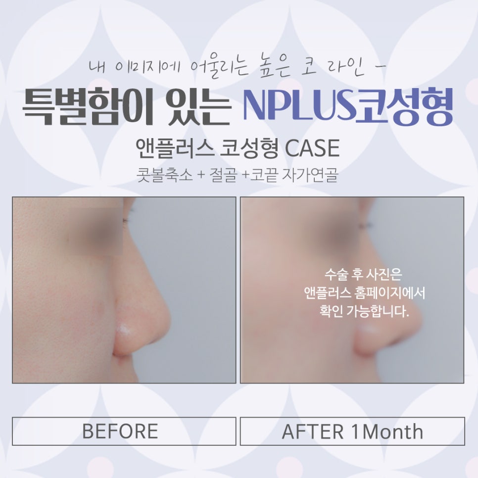 코성형잘하는곳에서 자연스럽고 예쁘게 관련 이미지 14