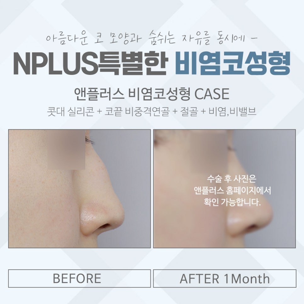비염코수술후기 자세하게 알아보고 관련 이미지 14