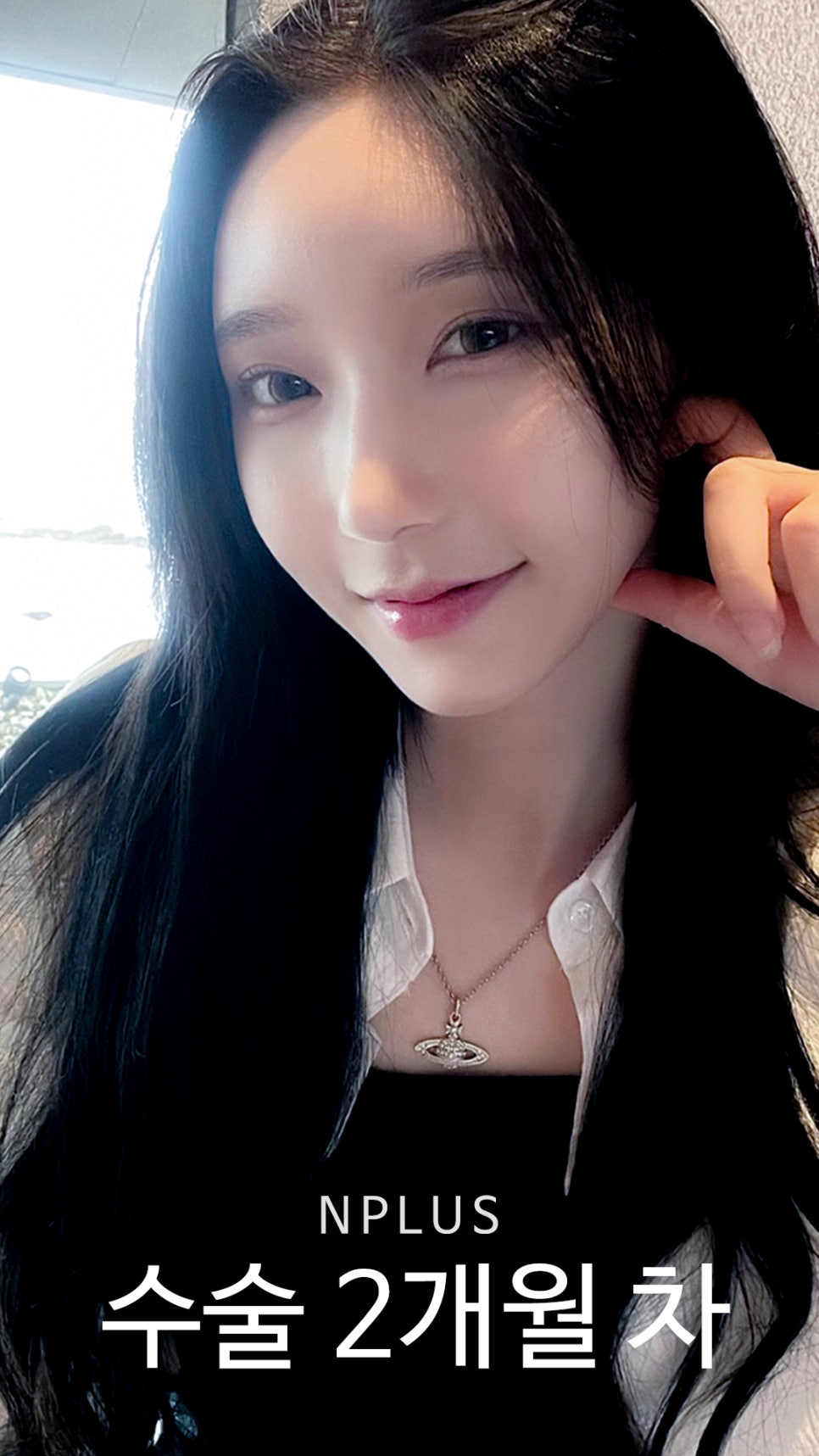 기본코성형후기 절골 + 무보형물 코성형 + 코끝 비중격 연골, 귀 연골 관련 이미지 9
