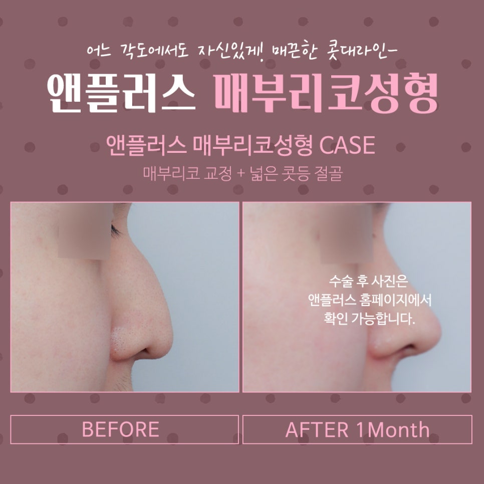 코끝처짐 개선한 매부리코성형후기 관련 이미지 12