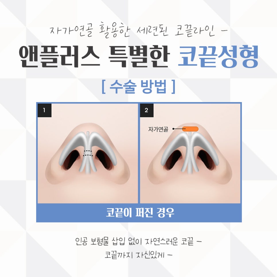 Nose Tip Surgery Review: Natural Results with Nose Tip Cartilage Stitching image 12