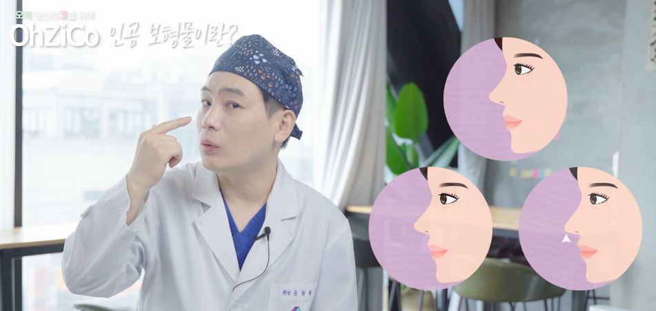 Everything About the Implants Used in Nasal Bridge Surgery image 3