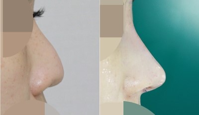 비염코성형 수술 전vs직후 사진 관련 이미지 1