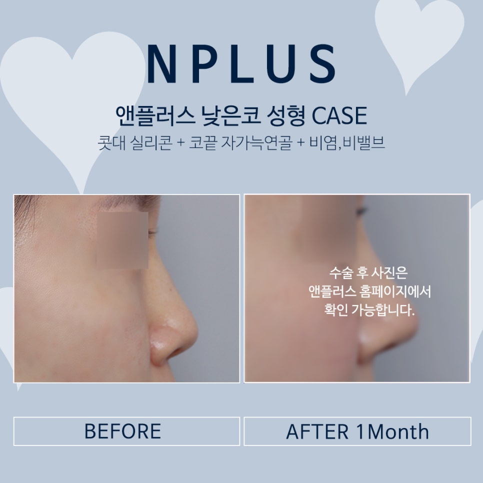 낮은코성형_자가늑연골 활용하여 오똑하게 관련 이미지 3