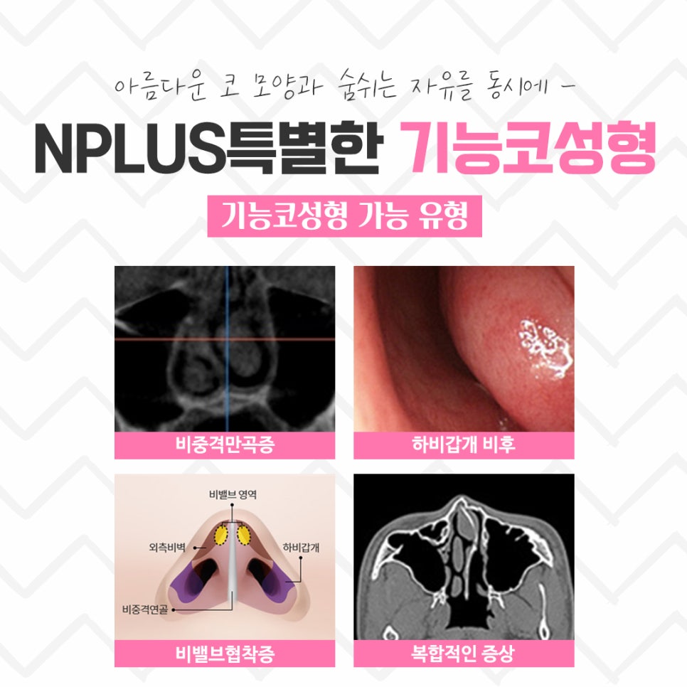 기능코수술후기 정확한 진단을 통해 관련 이미지 6