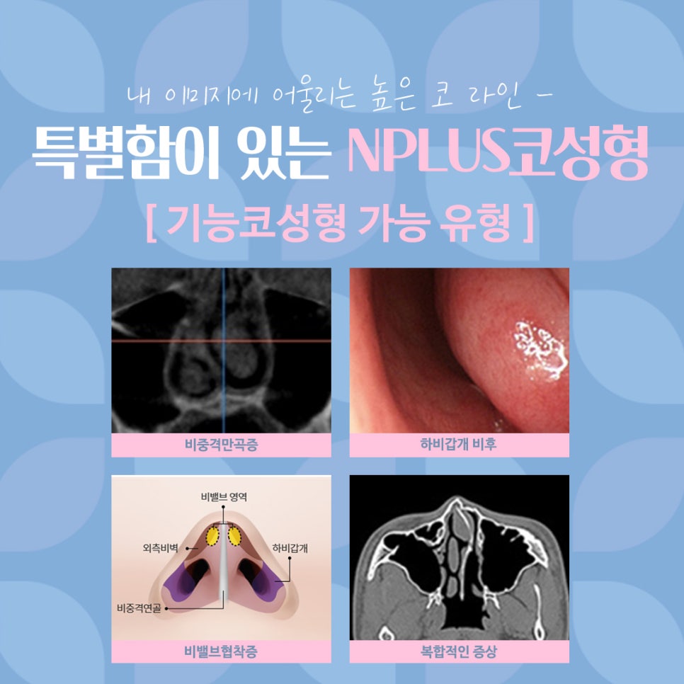 여자코수술후기 코 내부까지 확인하고 관련 이미지 6