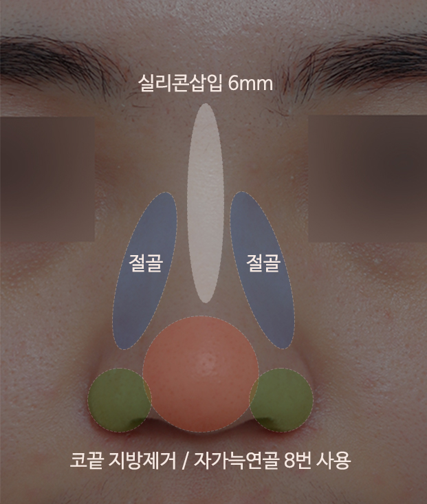 복코수술후기_뭉툭한 코라인을 자연스럽게 관련 이미지 6