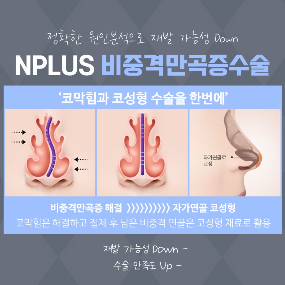 비중격코성형 정확한 원인 파악으로 관련 이미지 10