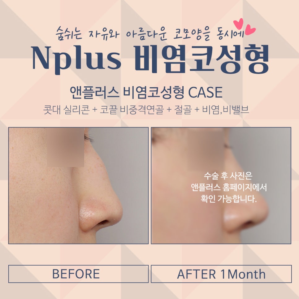 비염수술 정확한 진단으로 관련 이미지 10