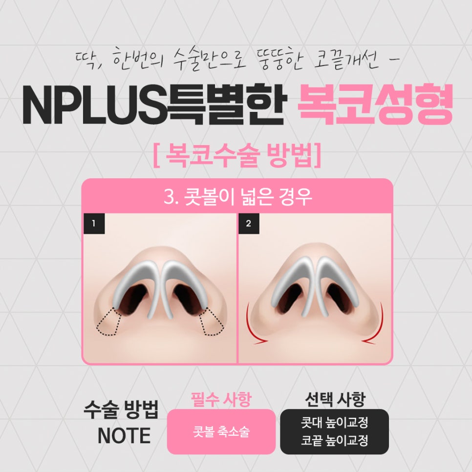 복코성형 세련된 이미지로 관련 이미지 11