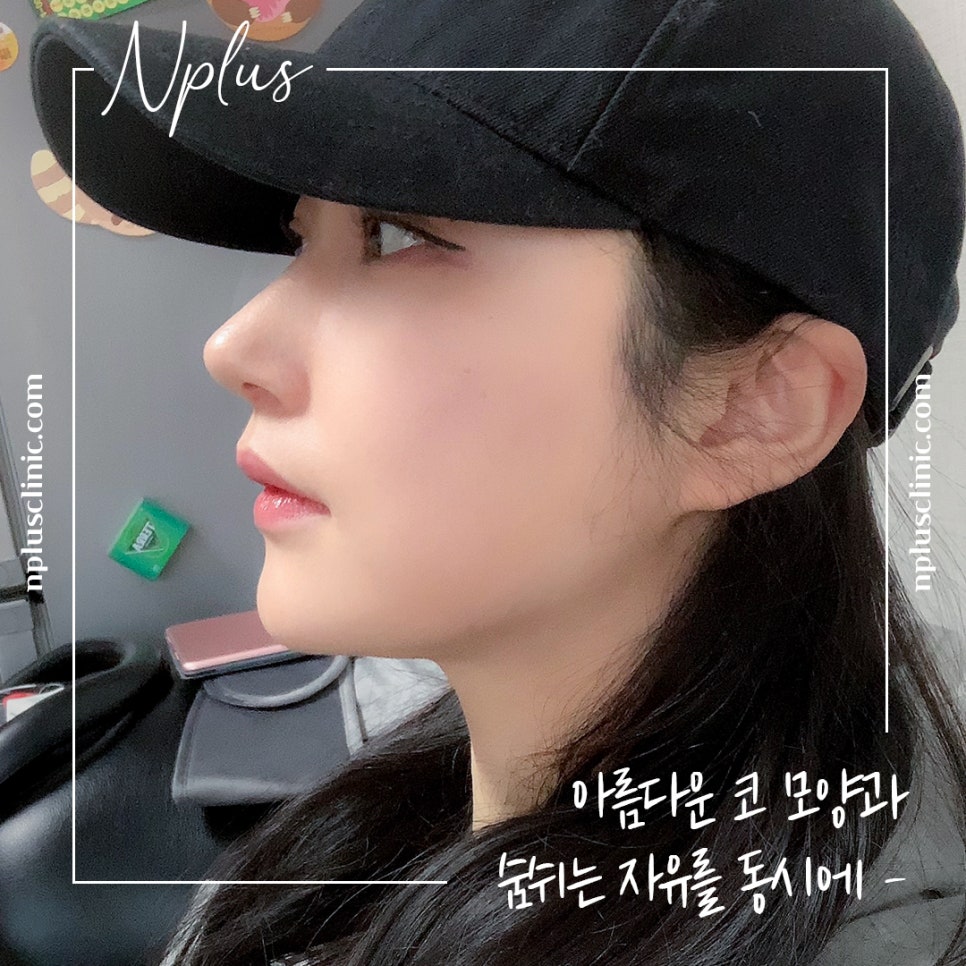 Make Sure to Review Rhinoplasty Costs Carefully Before Deciding image 1