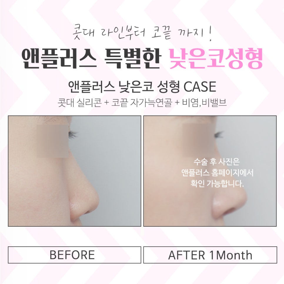 낮은코수술후기 확인하고 예쁜 라인으로 관련 이미지 14