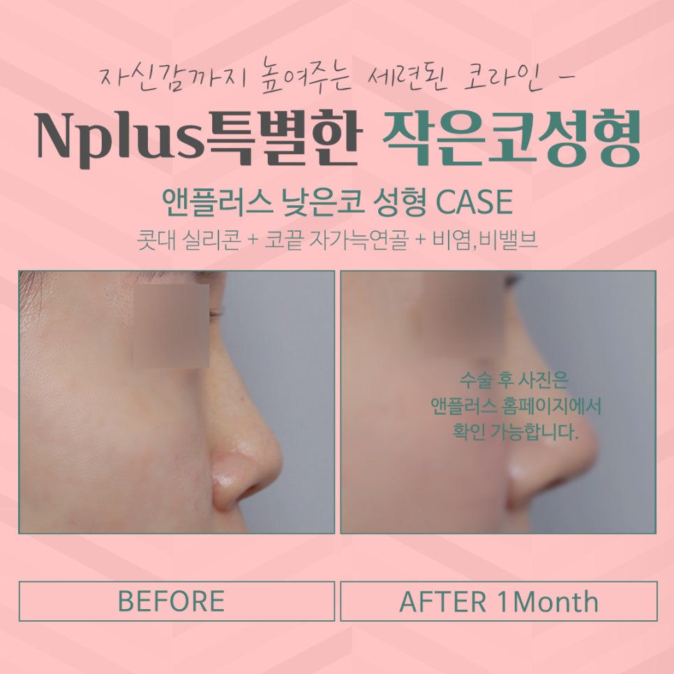Small Nose Surgery for a Beautiful Nose Line image 8