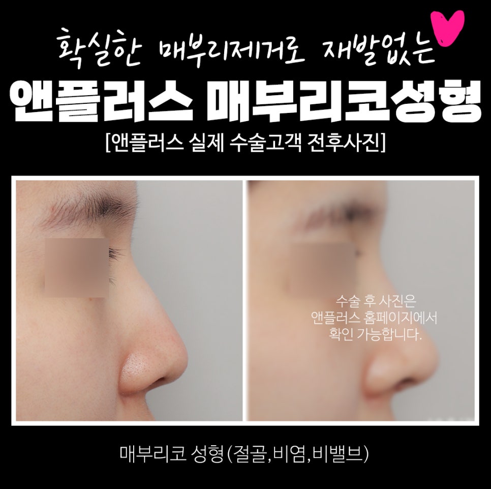 매부리코수술후기_완벽한 매부리제거로 깔끔하게 관련 이미지 4