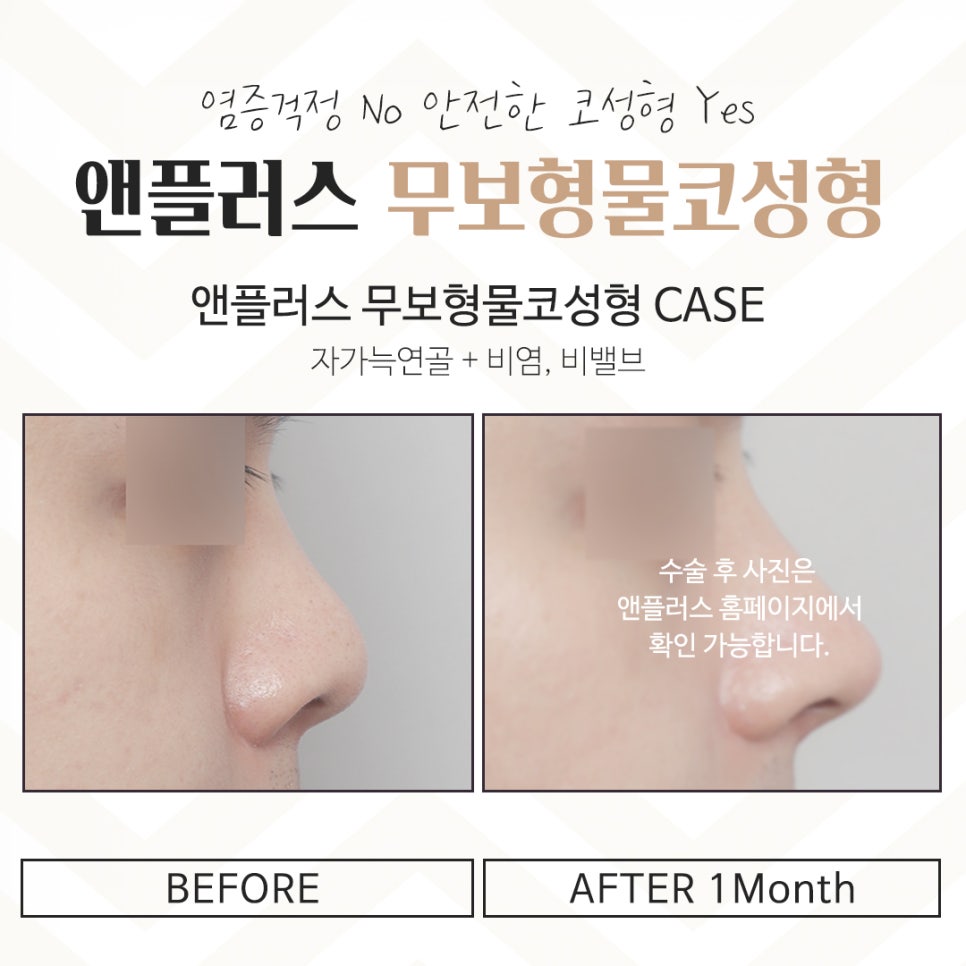 If You’re Looking for Reviews of Non-Implant Nose Surgery image 13