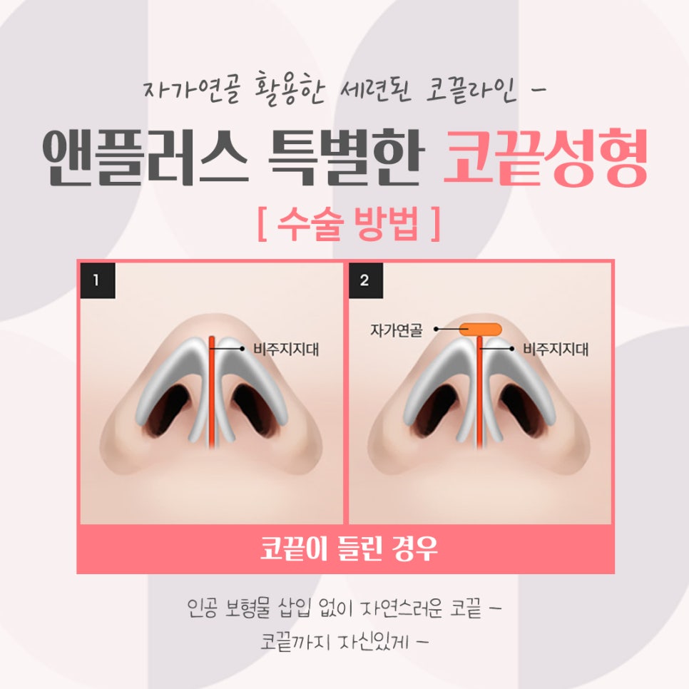 코끝성형후기로 세련된 코 라인 관련 이미지 9